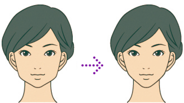 静脈麻酔による完全無痛麻酔下で施術を行い、切除は高周波メスを使用します※局所麻酔ご希望の場合、極細い針を使用しますので痛みは最小限です A-RISA
