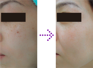 before → After thonlor clinic