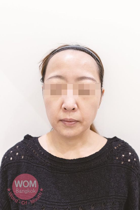 施術前 Renewme Skin Clinic