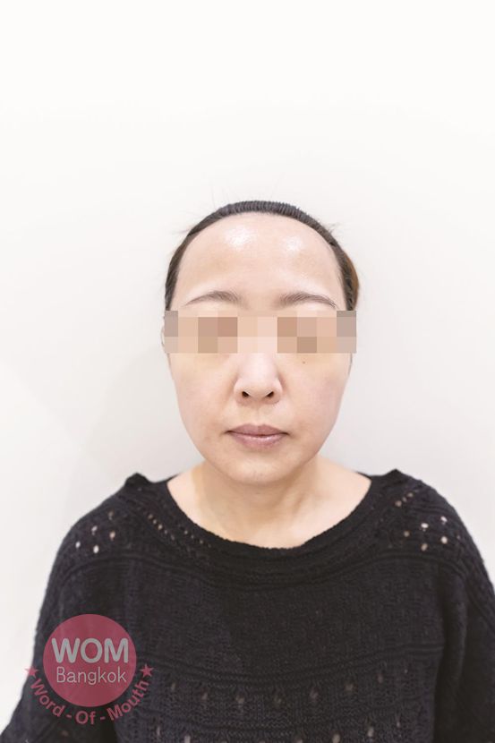 施術後 Renewme Skin Clinic
